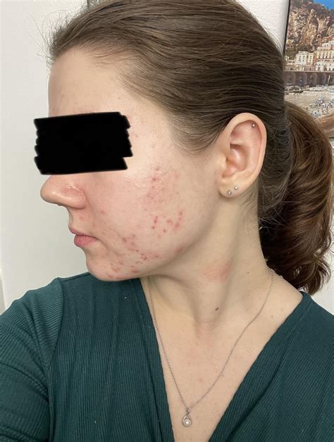 is 25 mg of spironolactone enough for acne|can spironolactone make acne worse.